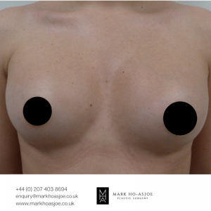 Breast Implants"