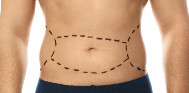 Mini Tummy Tuck
